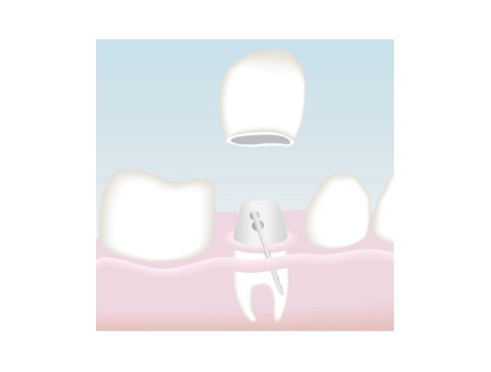 implantologia dental